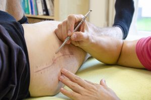 narbenbehandlung narbenbehandlung